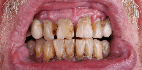 el tabaco y la salud de tus dientes