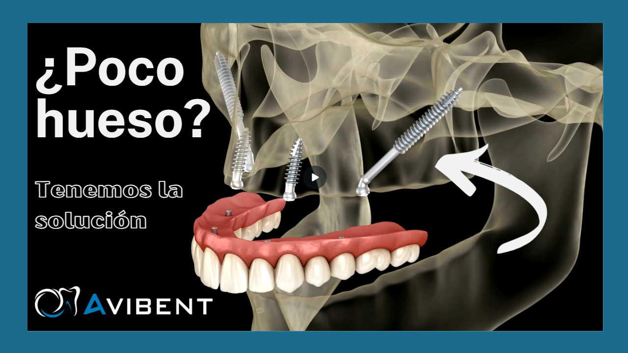 Implantes zigomáticos en Avibent clínica dental de confianza en Madrid