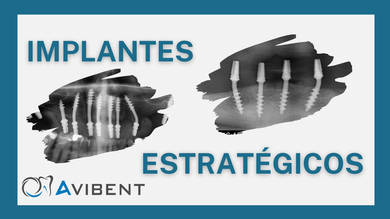 Implantes estratégicos o implantes basales en Avibent clínica dental de confianza en Madrid