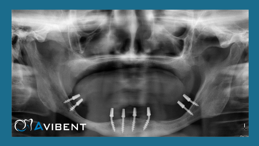 implantes estratégicos o basales colocados en un paciente con una gran reabsorción ósea en la mandíbula